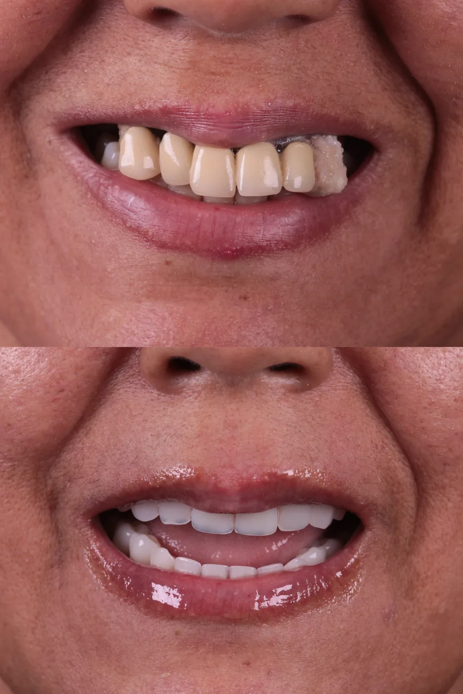 Resultado de tratamento 4